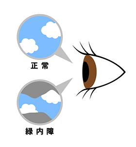 緑内障